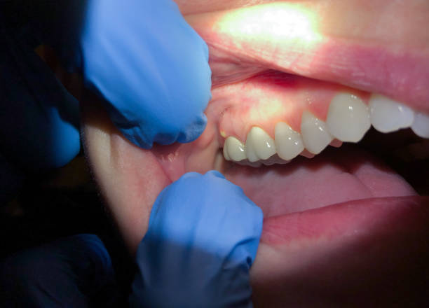 Best Chipped Tooth Repair Near Me  in Herriman, UT