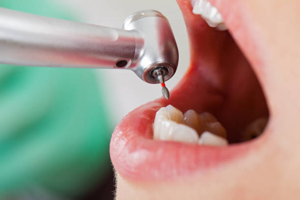 Best Knocked-Out Tooth Emergency  in Herriman, UT
